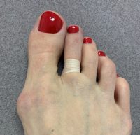 Снять отек после операции на пальце ноги