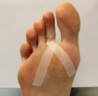Лечение пальцев ног после операции