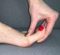 Отек ног после ампутации пальца