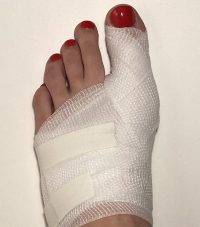 Снять отек после операции на пальце ноги